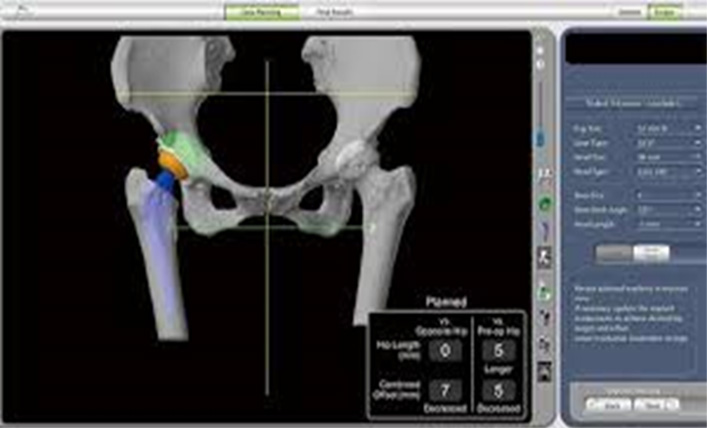 Pre-Planning and Segmentation of the CT SCAN image Robotic Hip Replacement Surgery